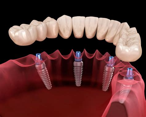 diş implant ameliyatı izle